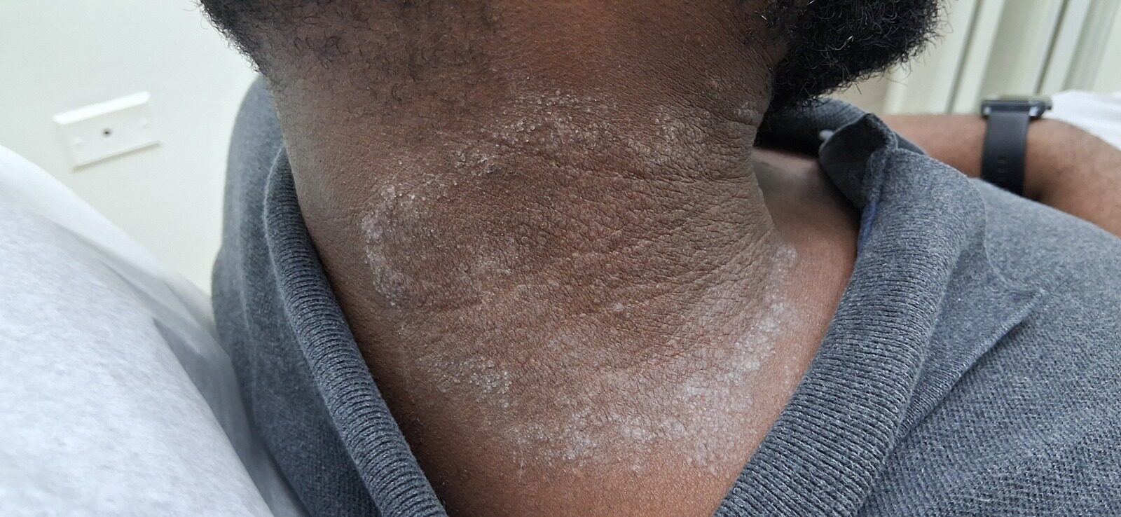 Antes - Caso clínico: Dermatitis por contacto