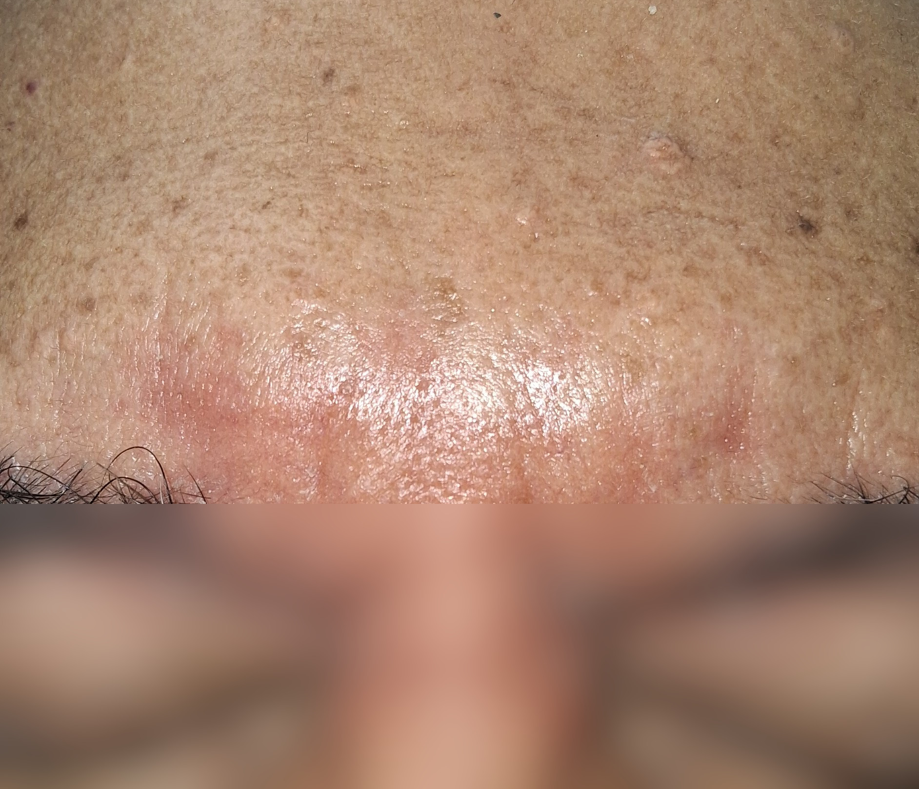 Antes - Caso clínico: Dermatitis seborreica
