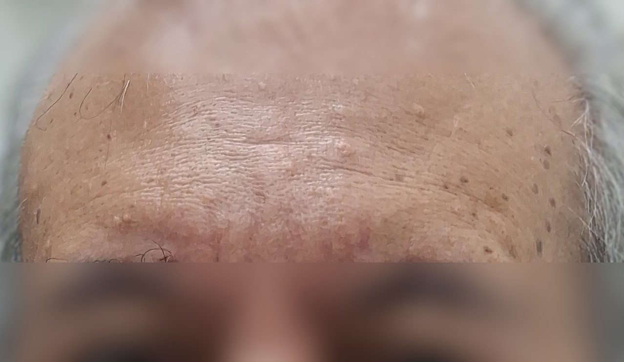 Después - Caso clínico: Dermatitis seborreica
