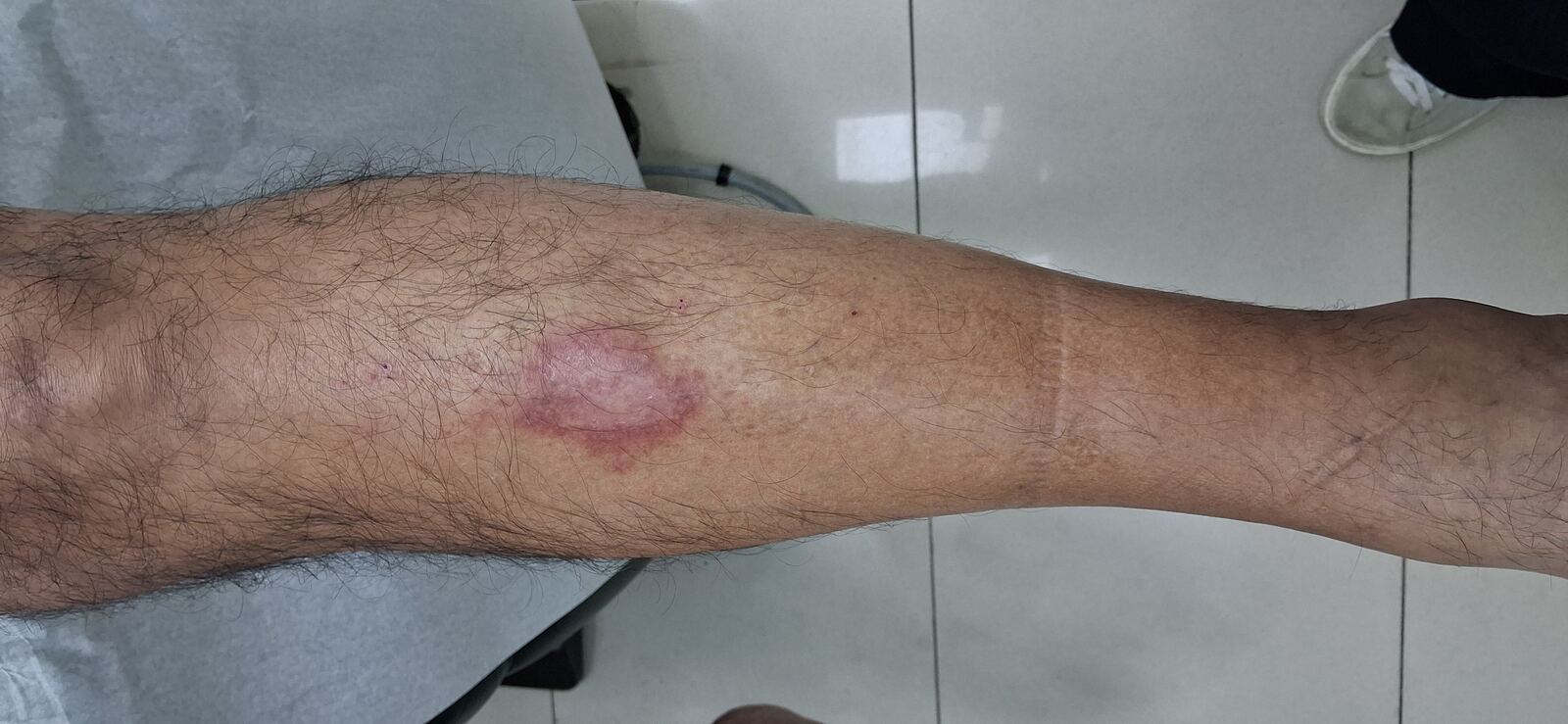 Caso clínico: Dermatitis