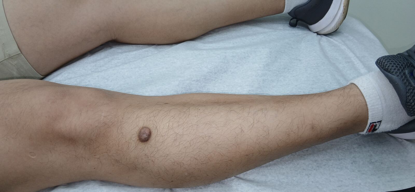 Antes - Caso clínico: Dermatofibroma y queloide