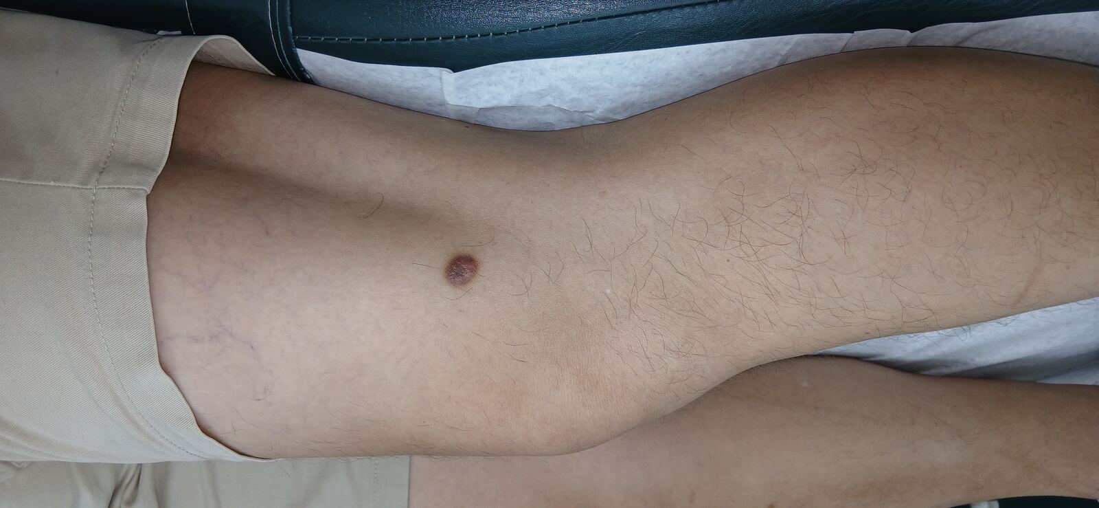 Después - Caso clínico: Dermatofibroma y queloide