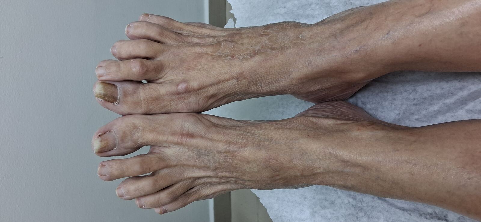 Caso clínico: Disqueratosis