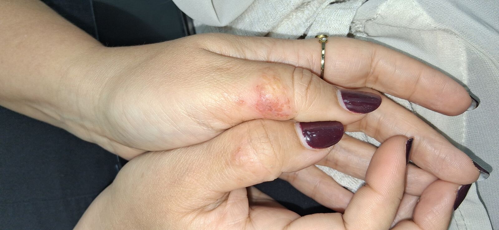 Antes - Caso clínico: Eczema atópico