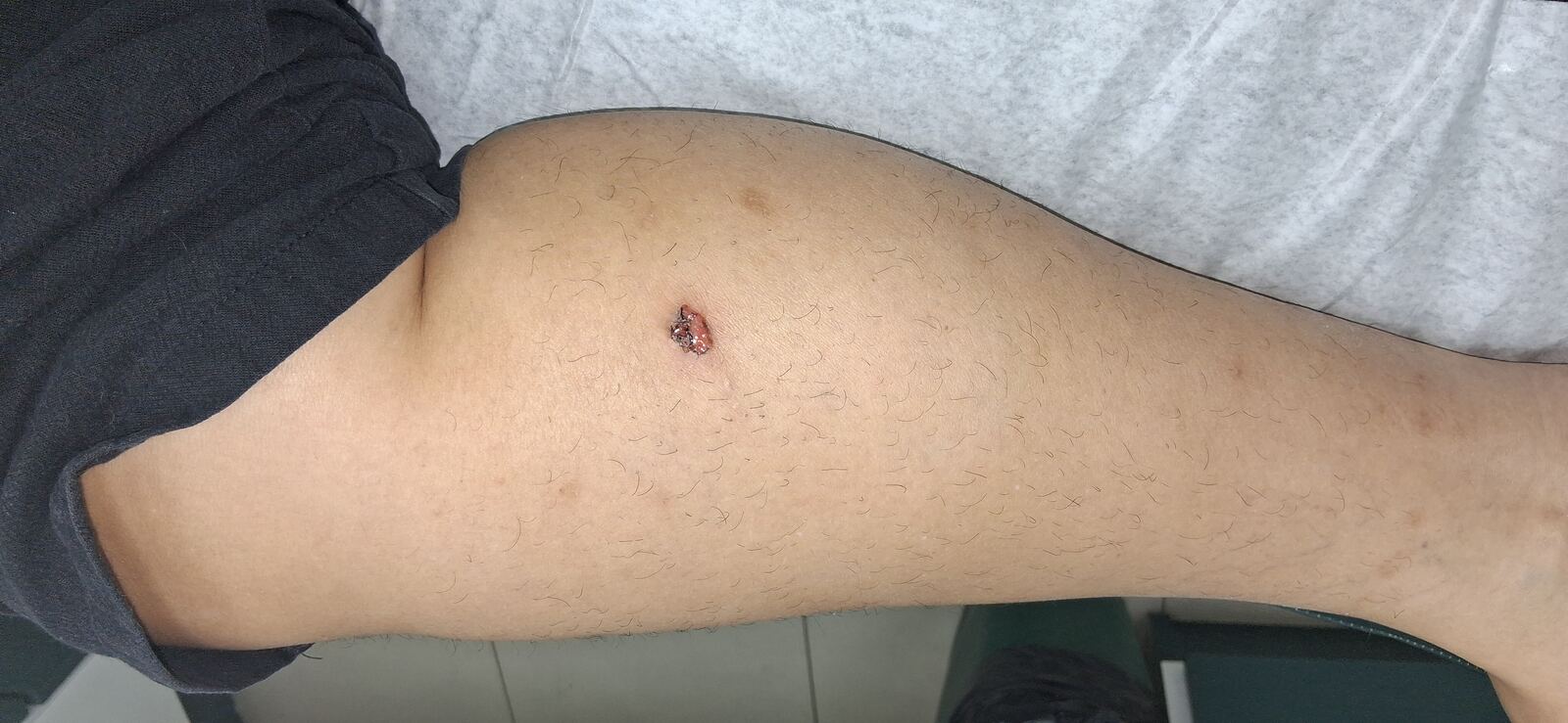 Después - Caso clínico: Eczema atópico