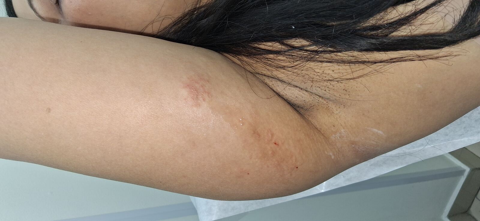 Caso clínico: Eczema atópico