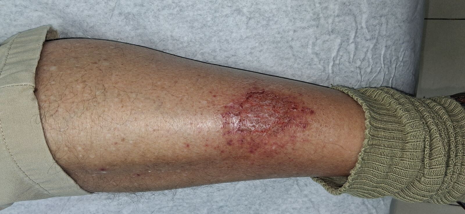 Antes - Caso clínico: Eczema de estasis y dermatitis craquelé
