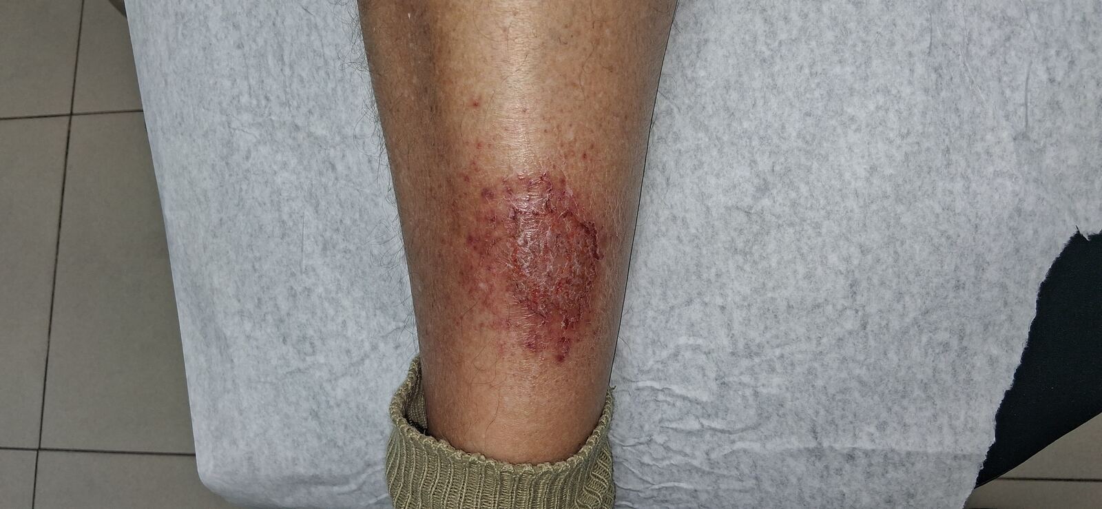 Después - Caso clínico: Eczema de estasis y dermatitis craquelé