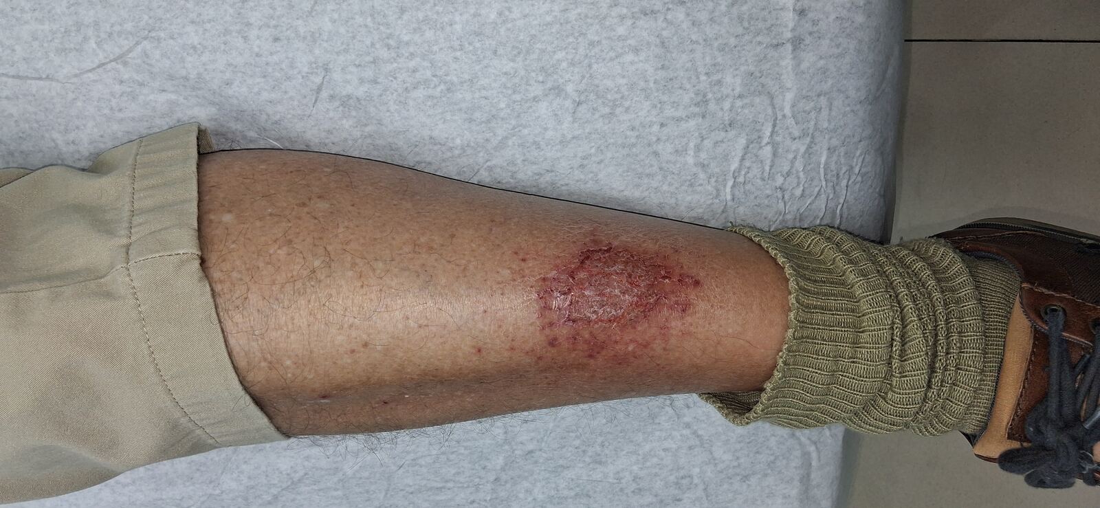 Caso clínico: Eczema de estasis y dermatitis craquelé
