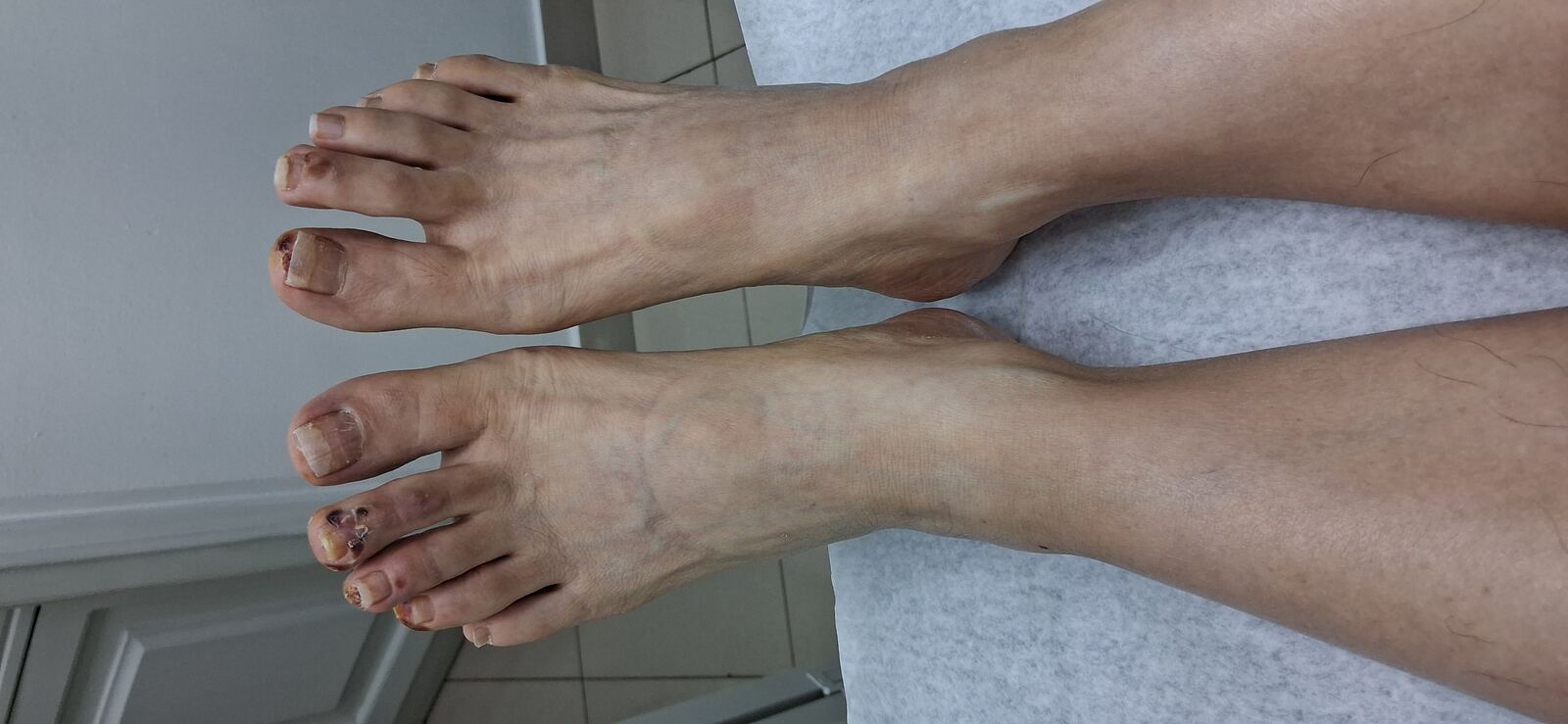 Después - Caso clínico: Eczema dishidrótico