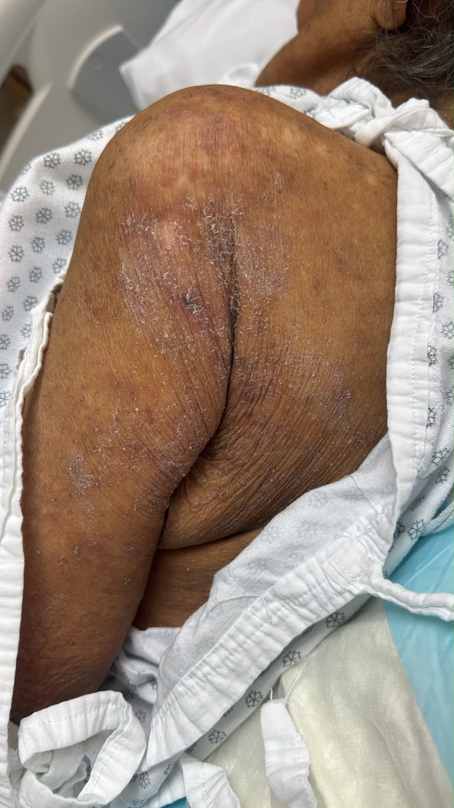 Escabiasis (Sarna): imagen antes