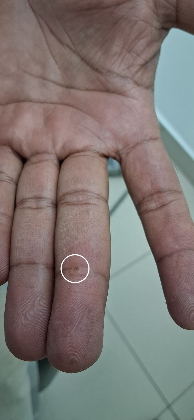Antes - Caso clínico: Fibroqueratoma vs verruga