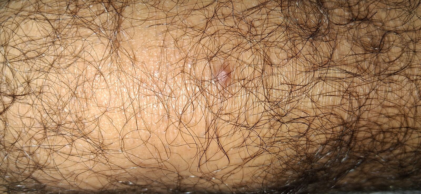 Después - Caso clínico: Fibroqueratoma vs verruga