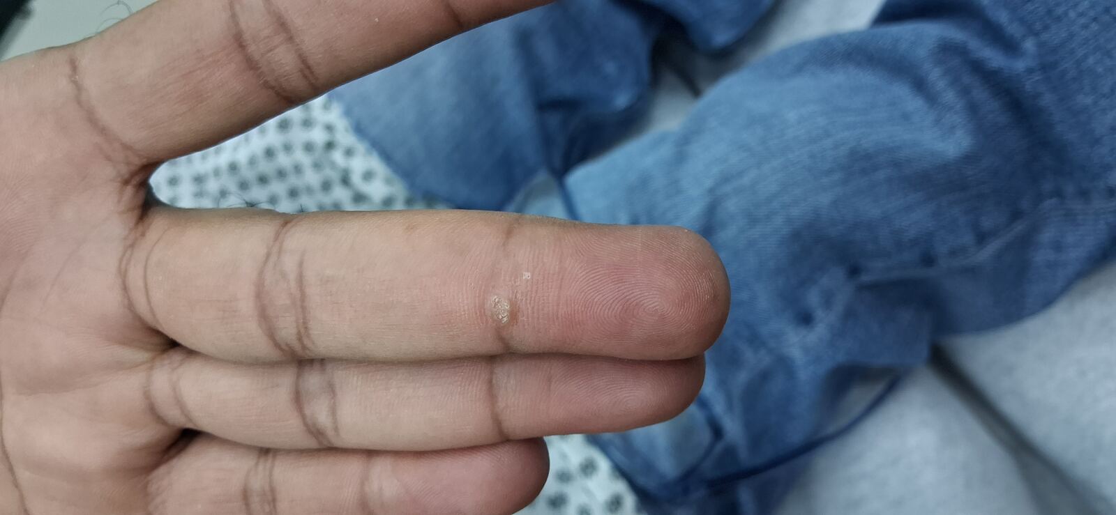 Caso clínico: Fibroqueratoma vs verruga