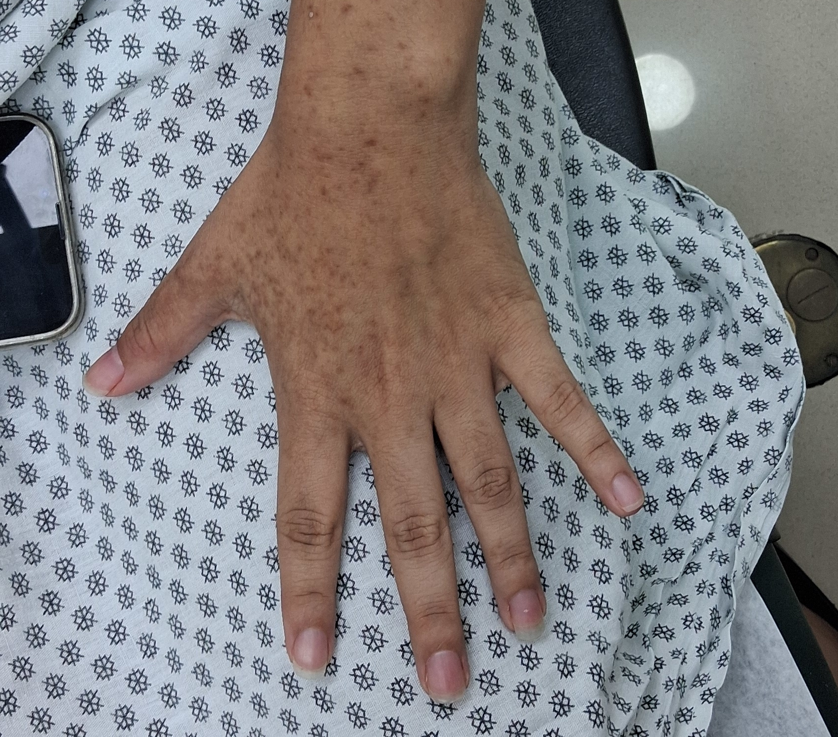Antes - Caso clínico: Fitofotodermatitis