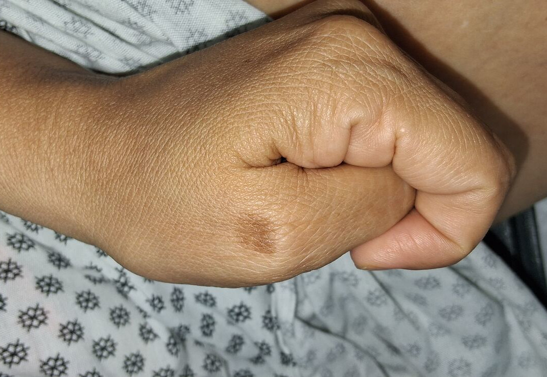 Caso clínico: Fitofotodermatitis