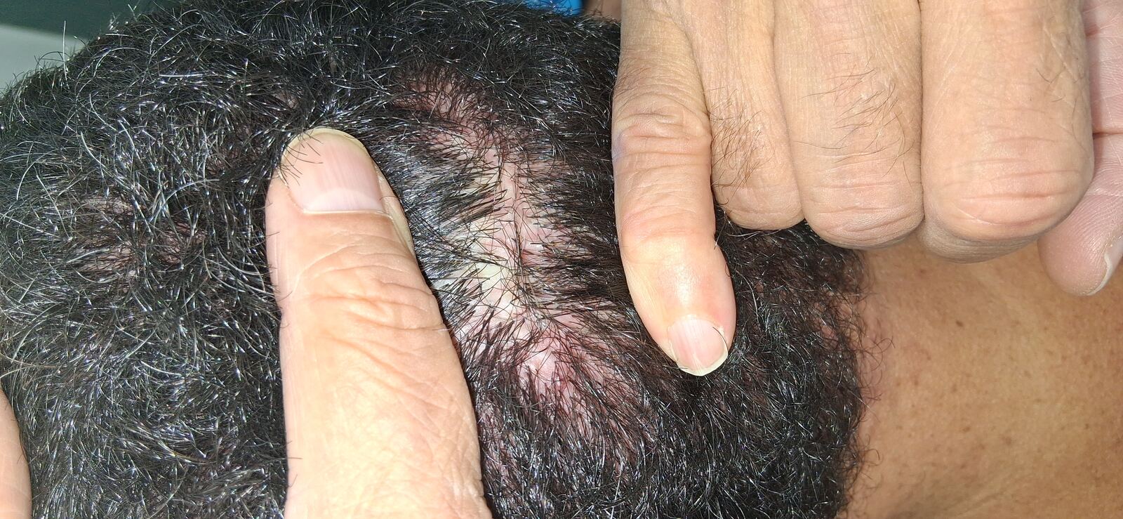 Antes - Caso clínico: Foliculitis decalvante