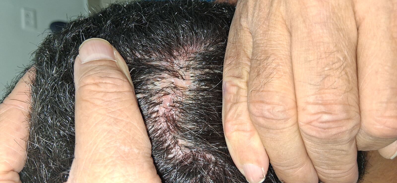 Caso clínico: Foliculitis decalvante