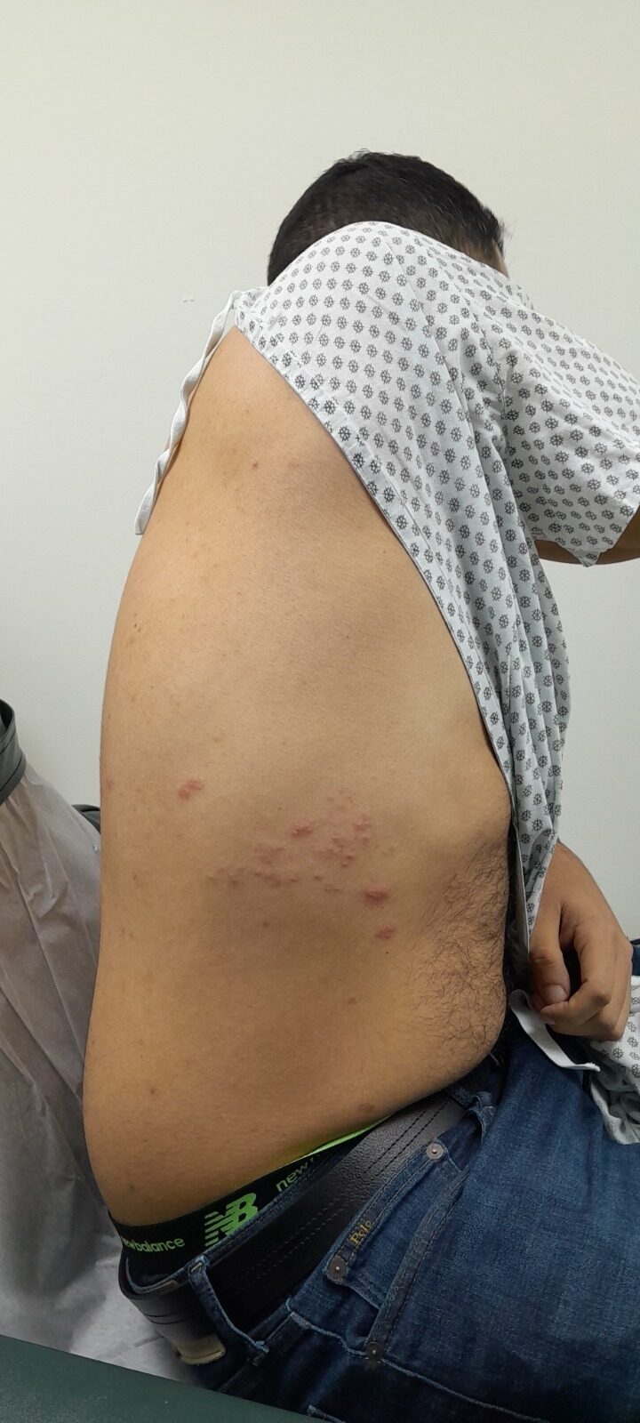 Antes - Caso clínico: Herpes zoster