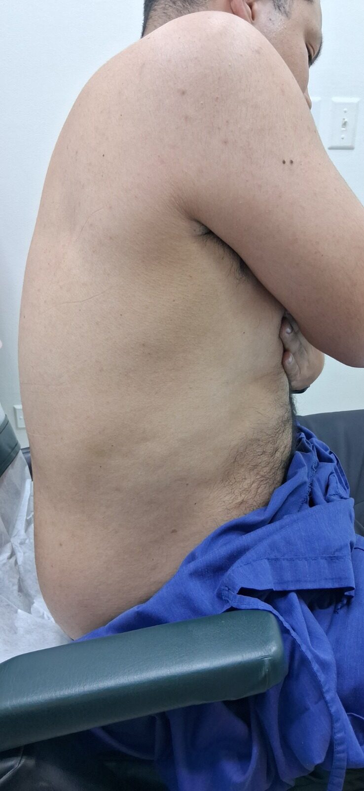 Después - Caso clínico: Herpes zoster
