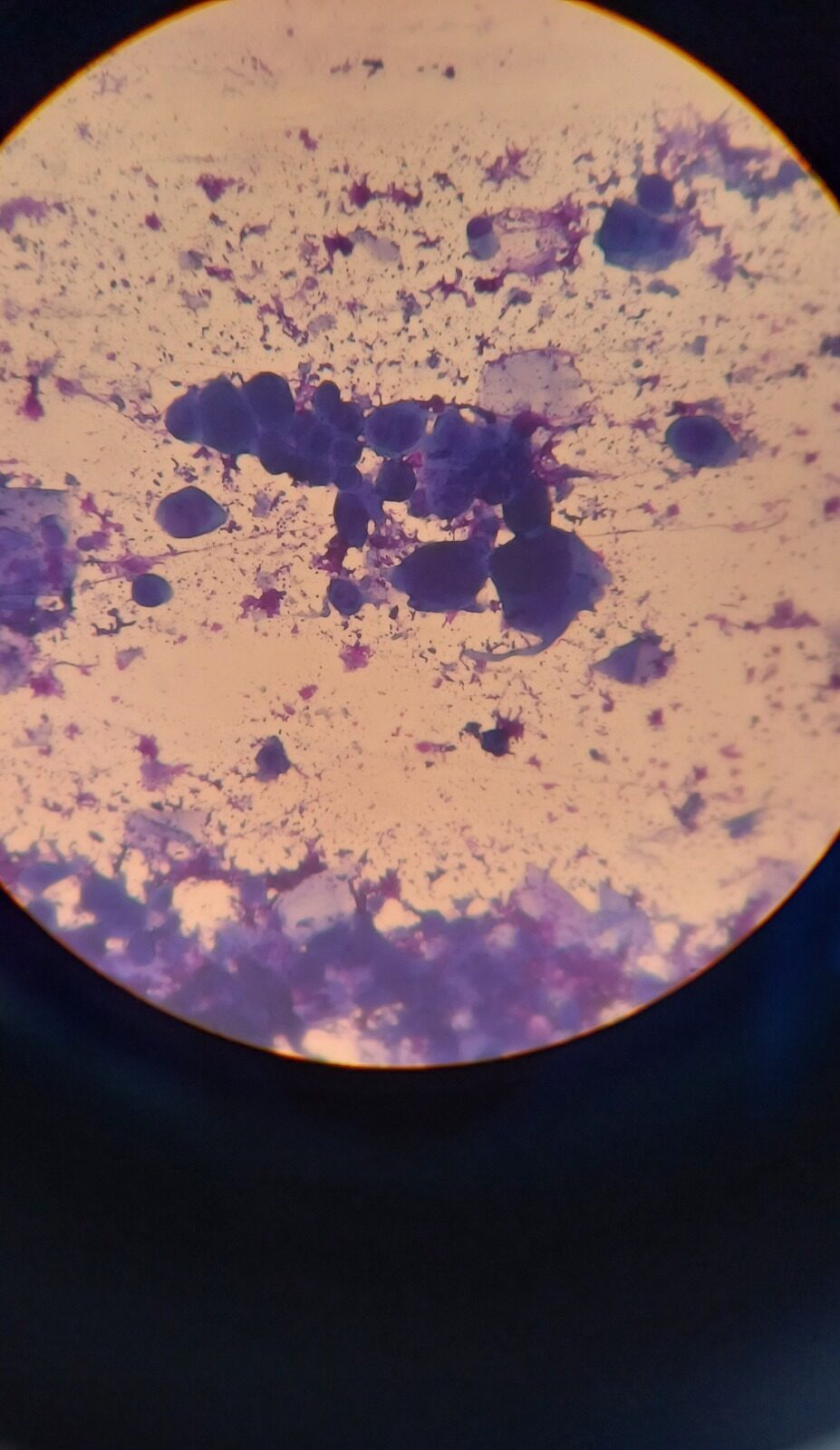 Caso clínico: Herpes zoster
