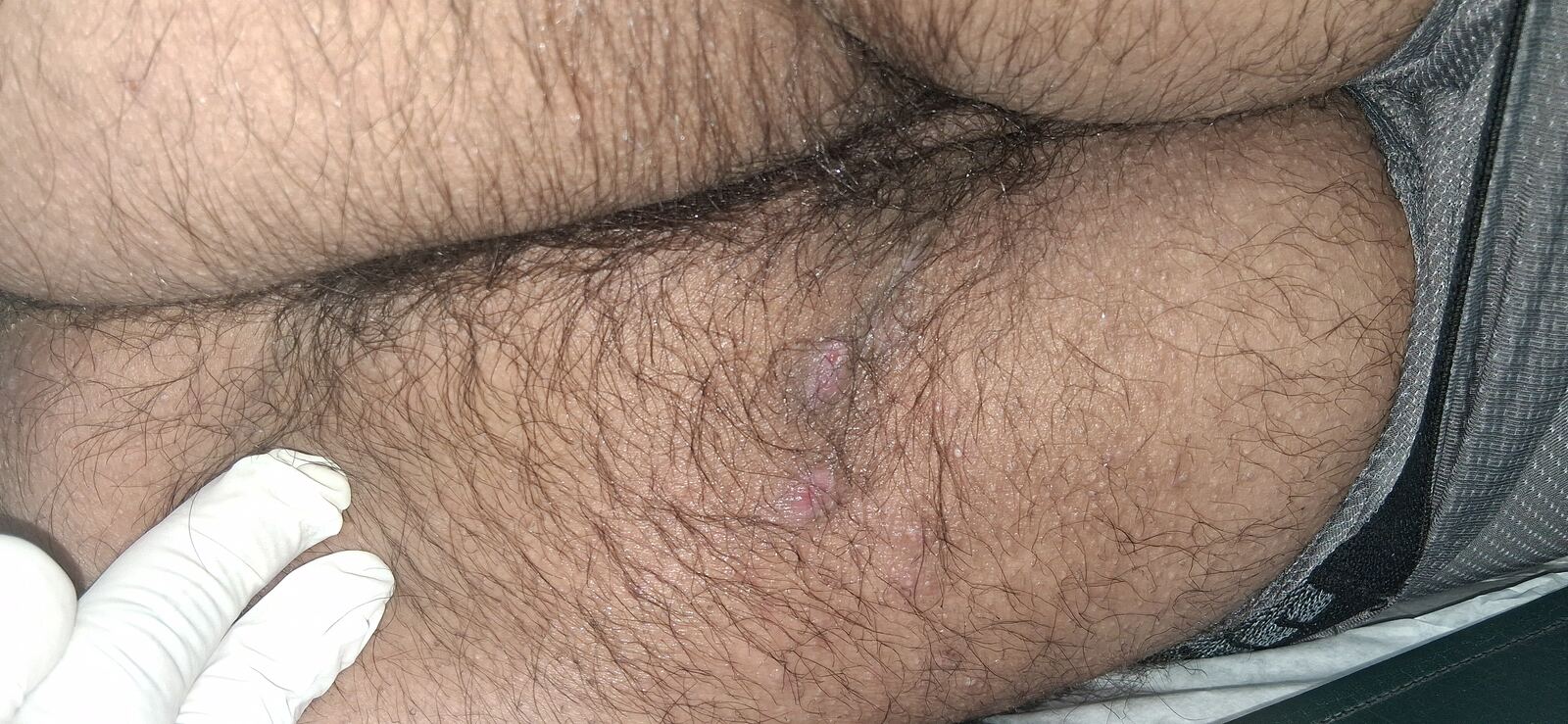 Antes - Caso clínico: Hidradenitis supurativa