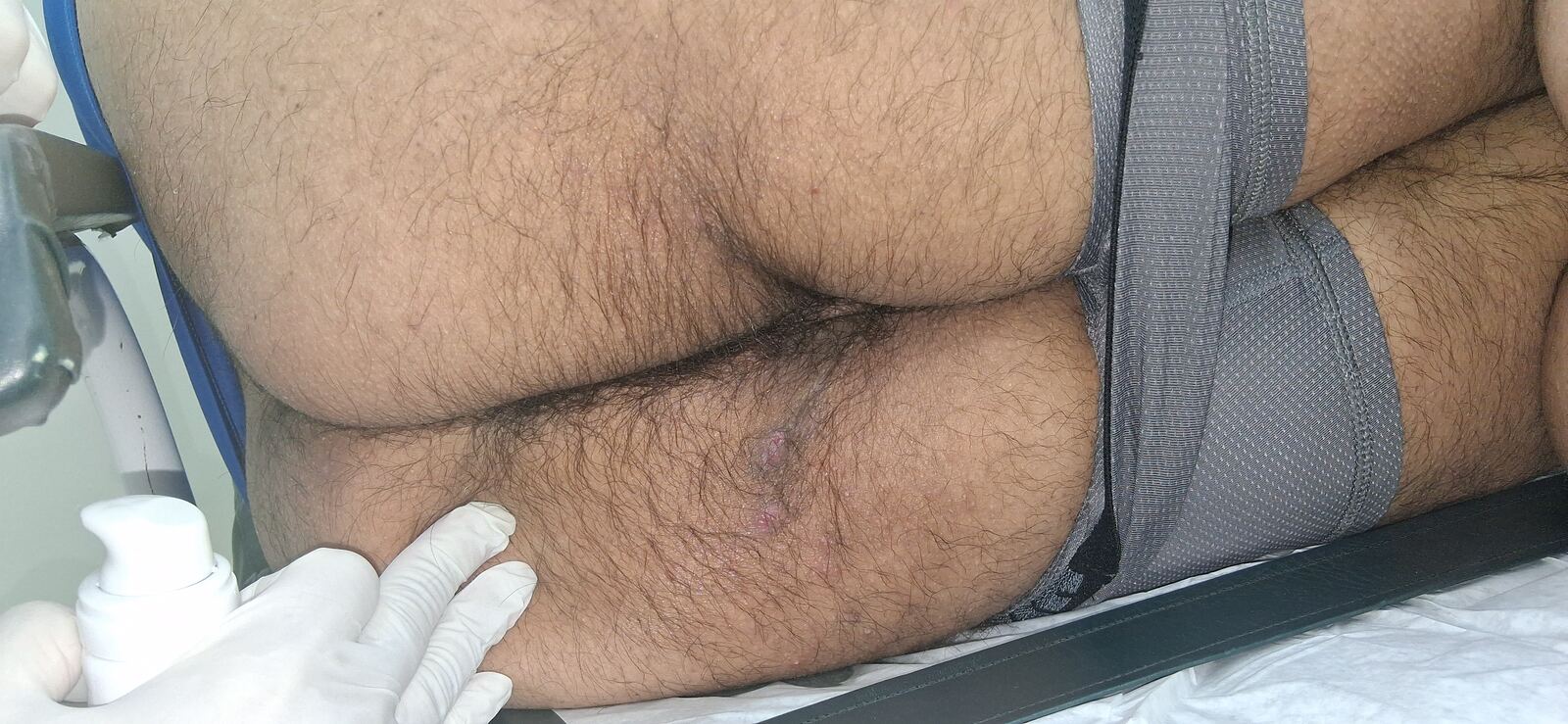 Caso clínico: Hidradenitis supurativa
