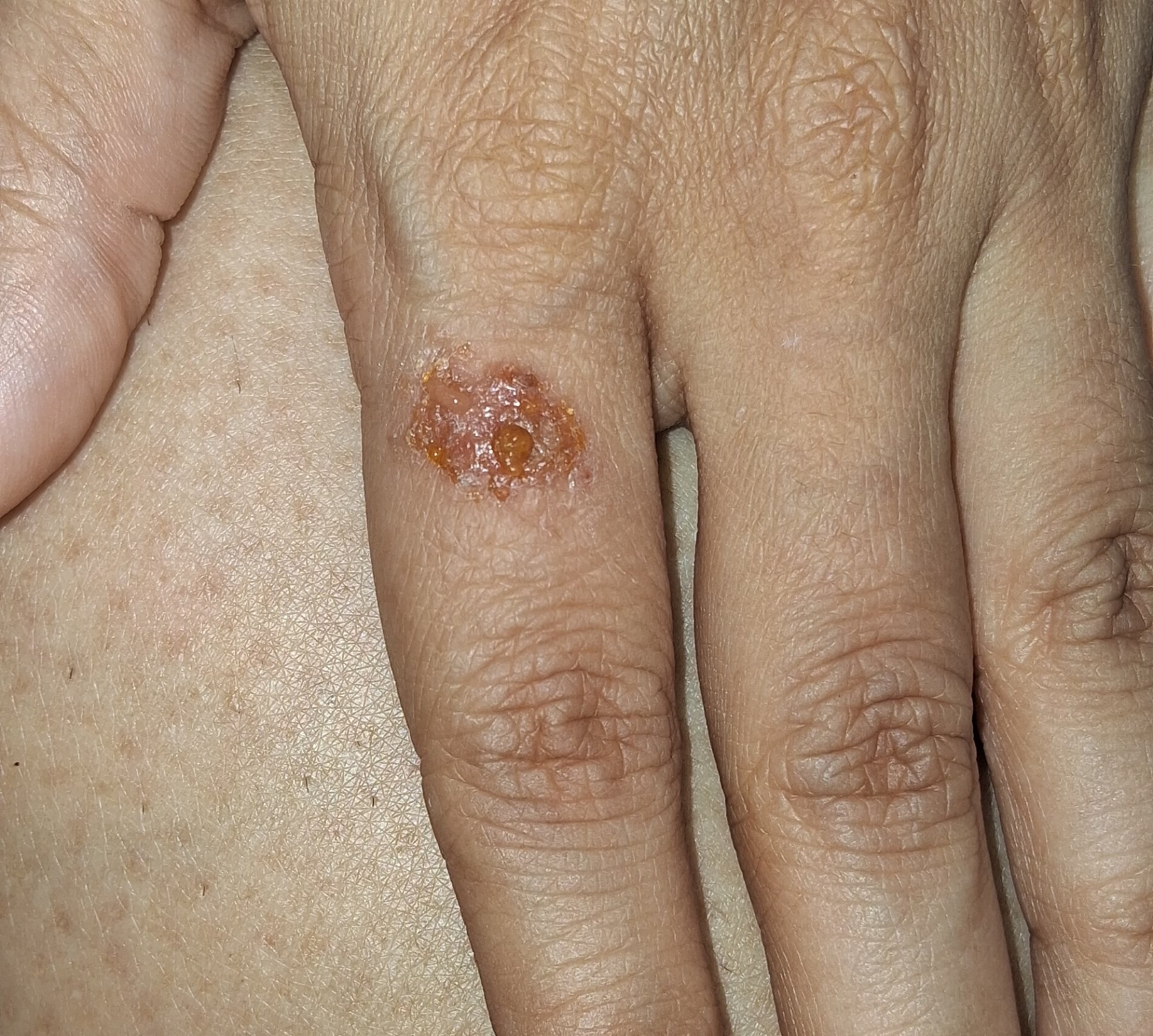 Impétigo contagioso: imagen antes