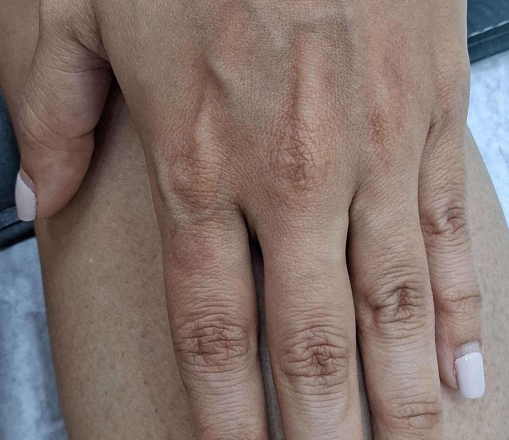 Impétigo contagioso: imagen después
