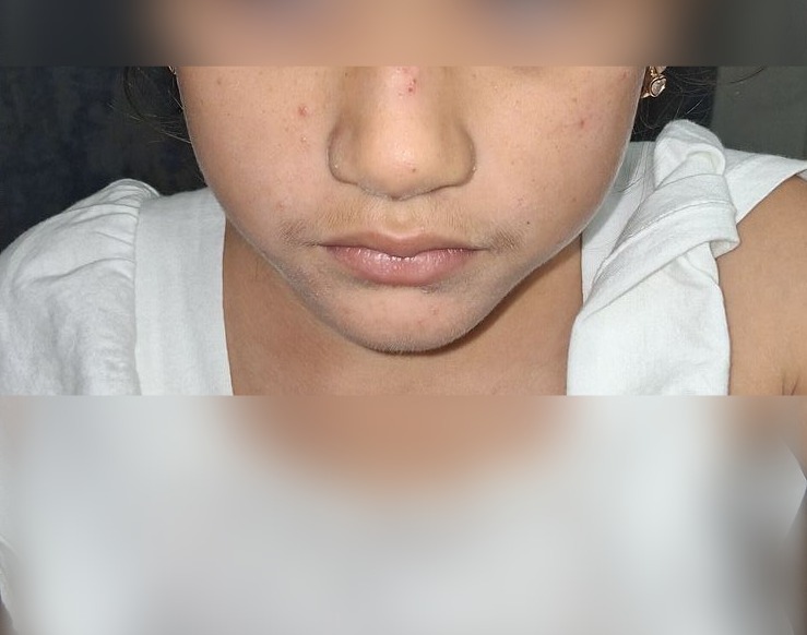 Caso clínico: Impétigo contagioso