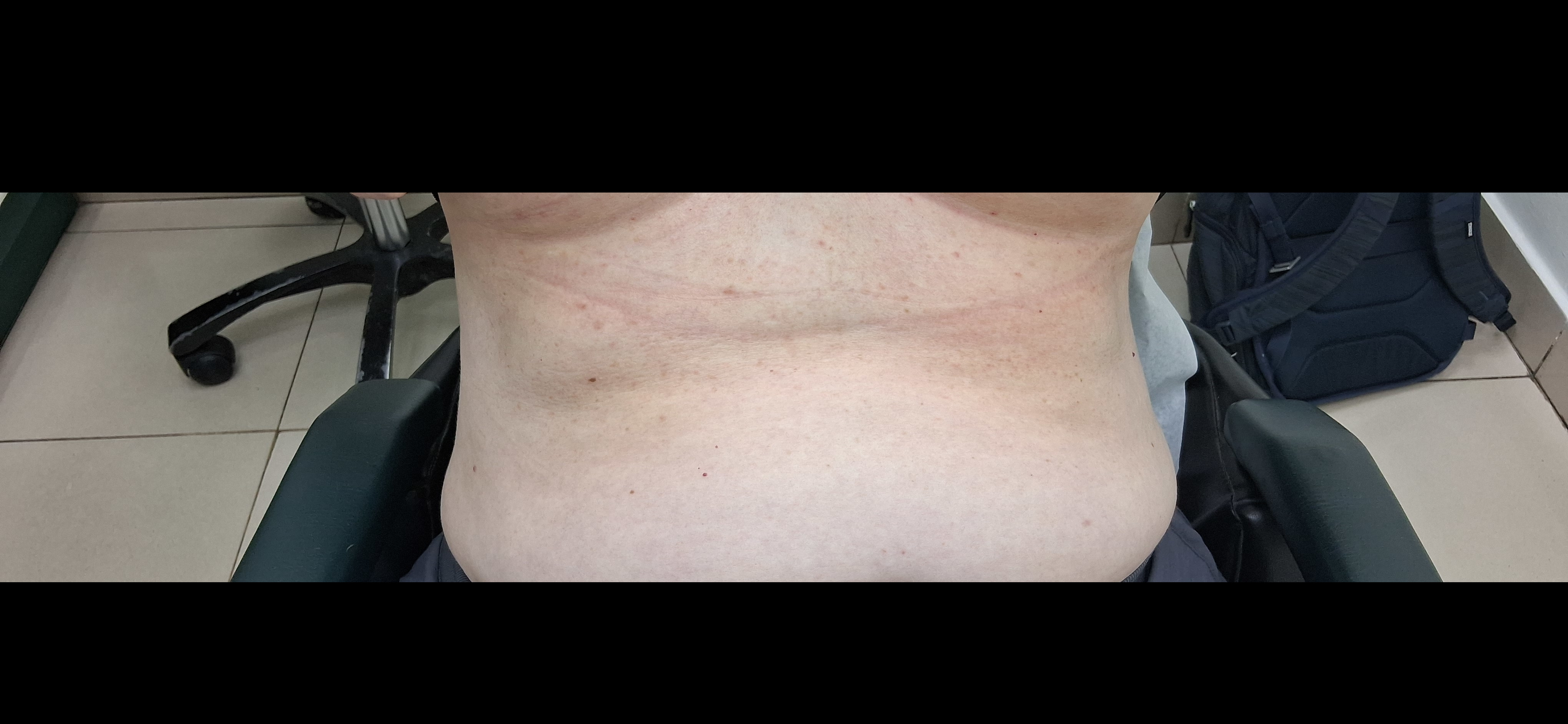 Intertrigo: imagen después