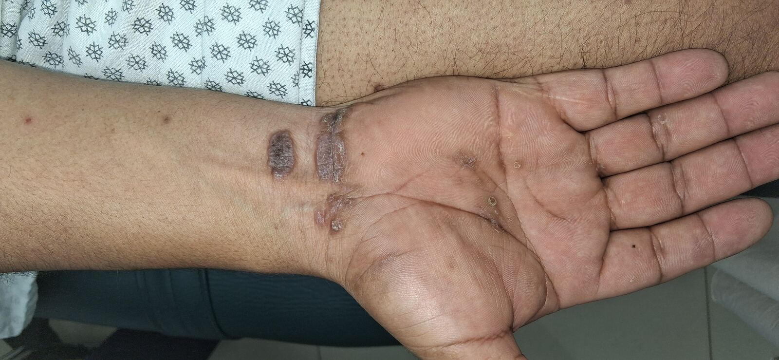 Antes - Caso clínico: Liquen plano