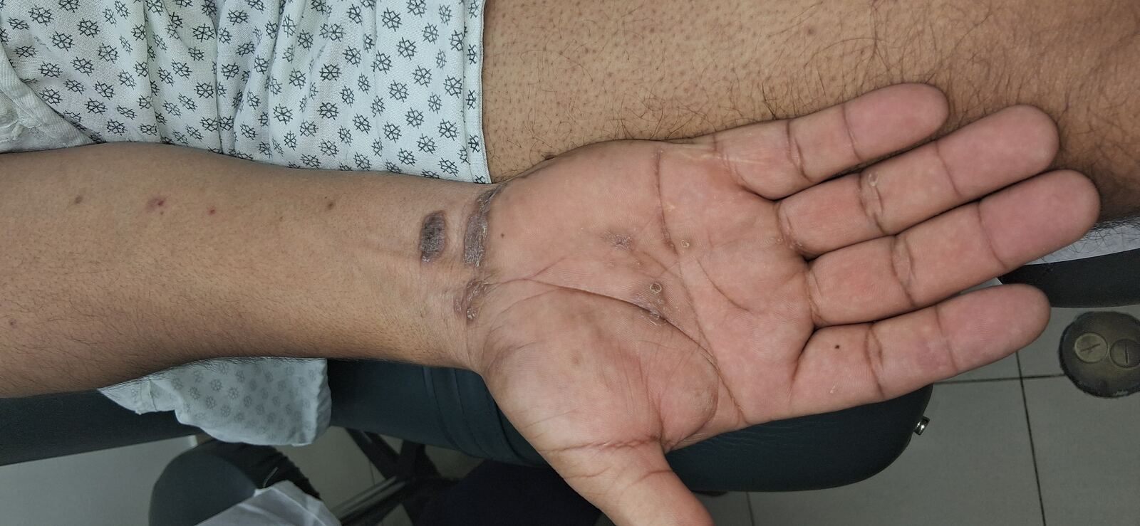 Caso clínico: Liquen plano