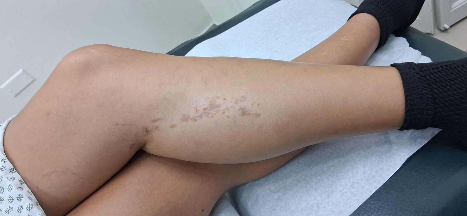 Después - Caso clínico: Liquen simplex crónico