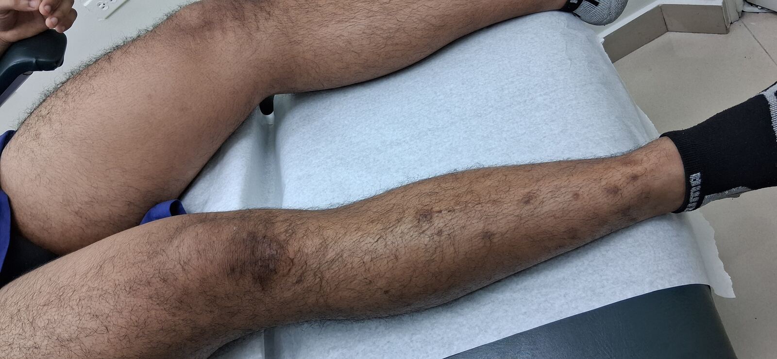 Caso clínico: Liquen simplex crónico