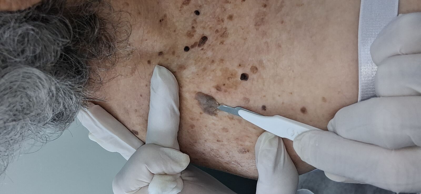 Antes - Caso clínico: Melanoacantoma
