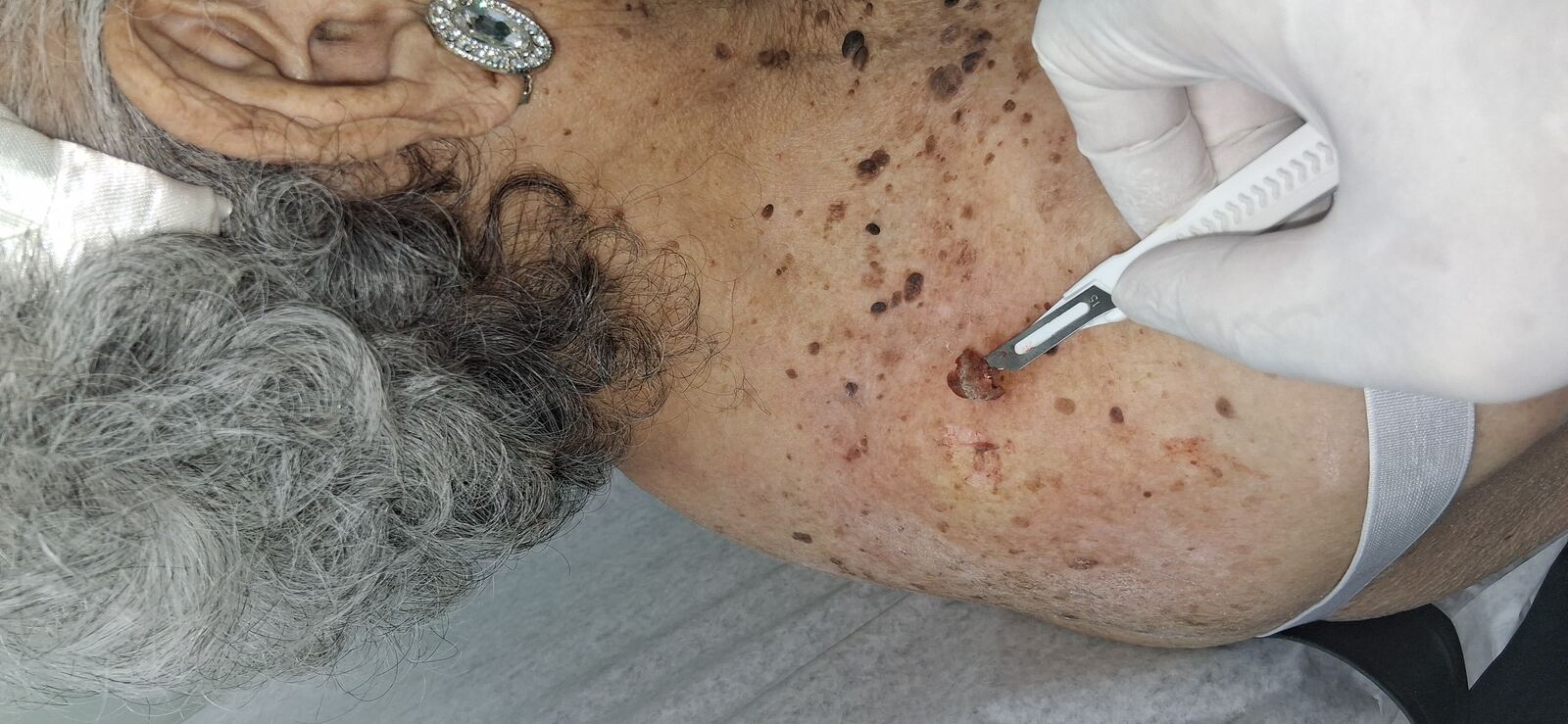Después - Caso clínico: Melanoacantoma