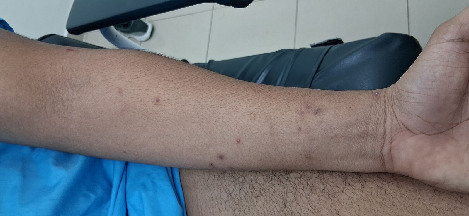 Antes - Caso clínico: Molusco contagioso