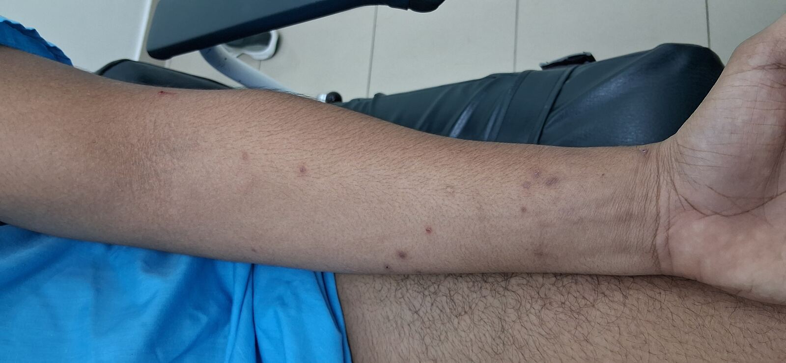Después - Caso clínico: Molusco contagioso