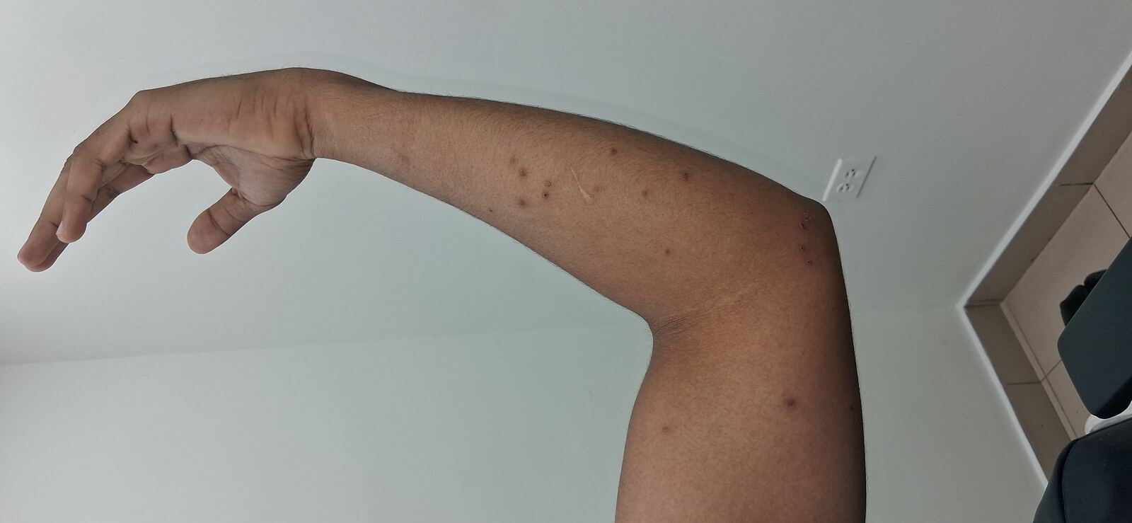 Caso clínico: Molusco contagioso
