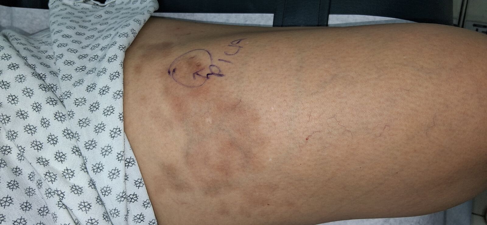 Antes - Caso clínico: Morfea