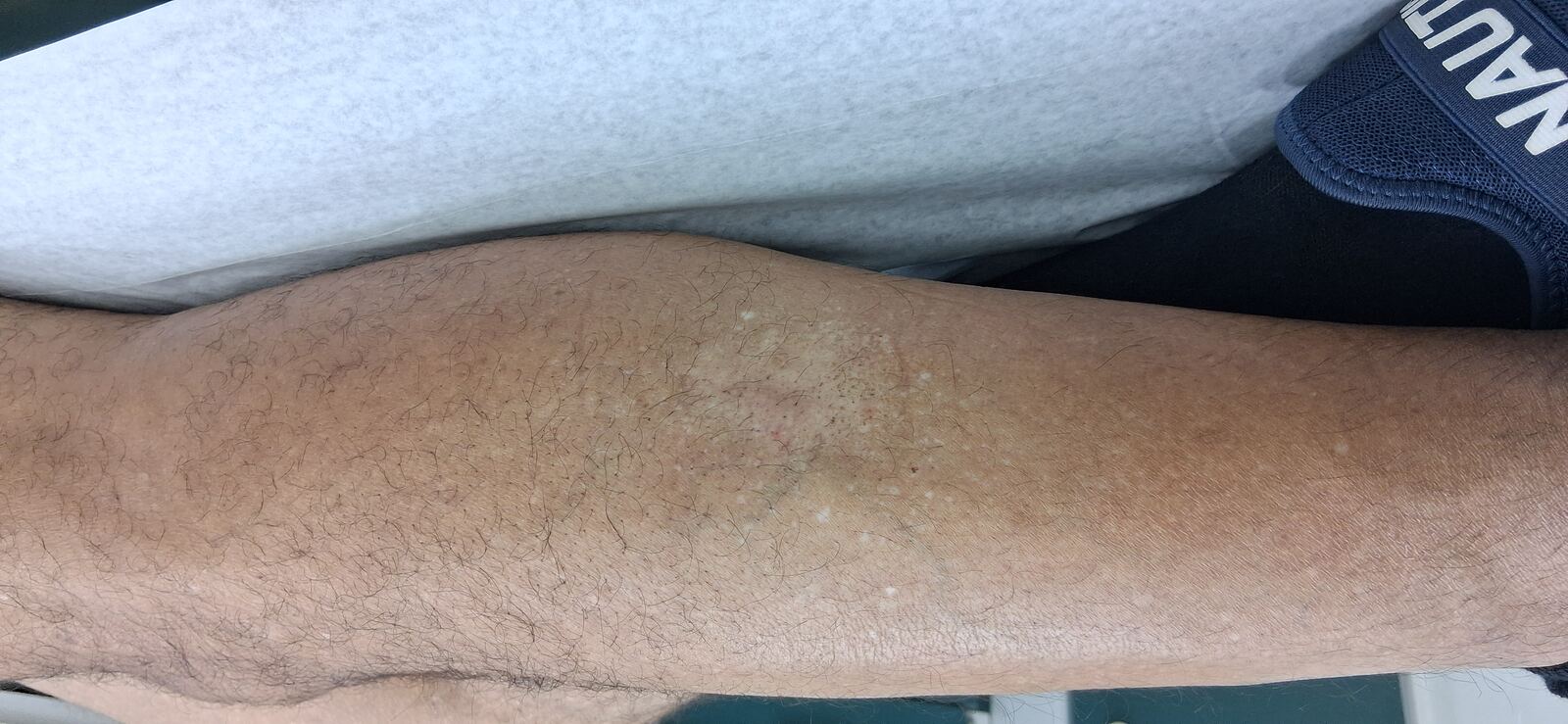 Antes - Caso clínico: Neurodermatitis