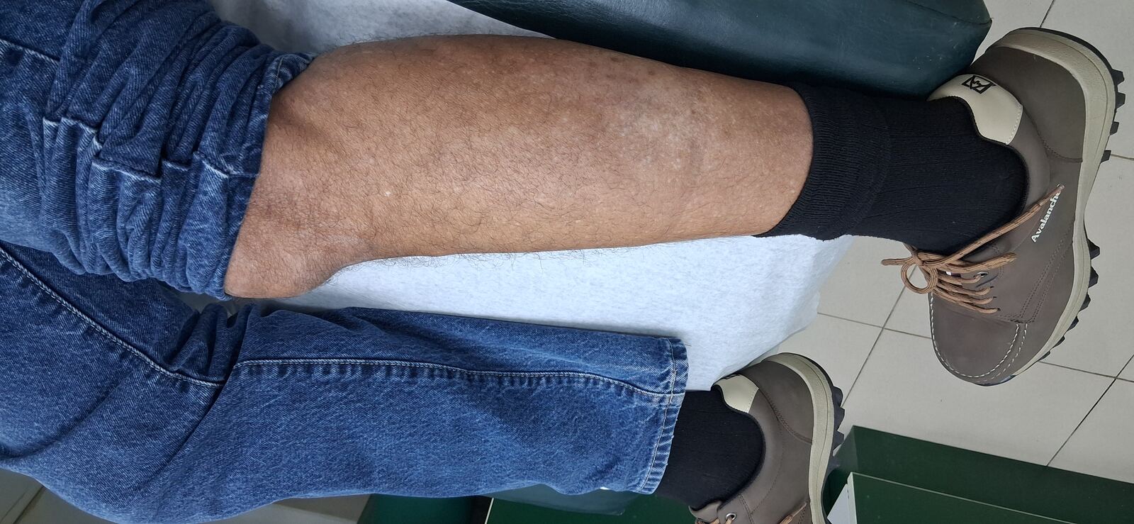 Después - Caso clínico: Neurodermatitis