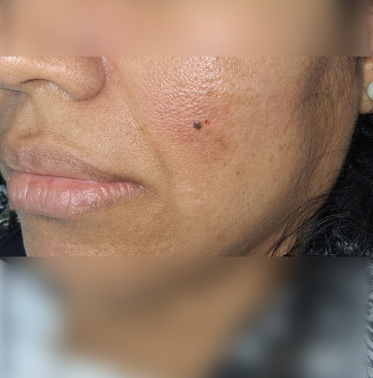 Antes - Caso clínico: Nevus compuesto