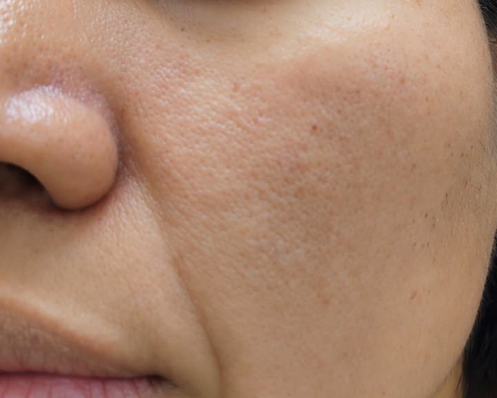 Nevus compuesto: imagen después
