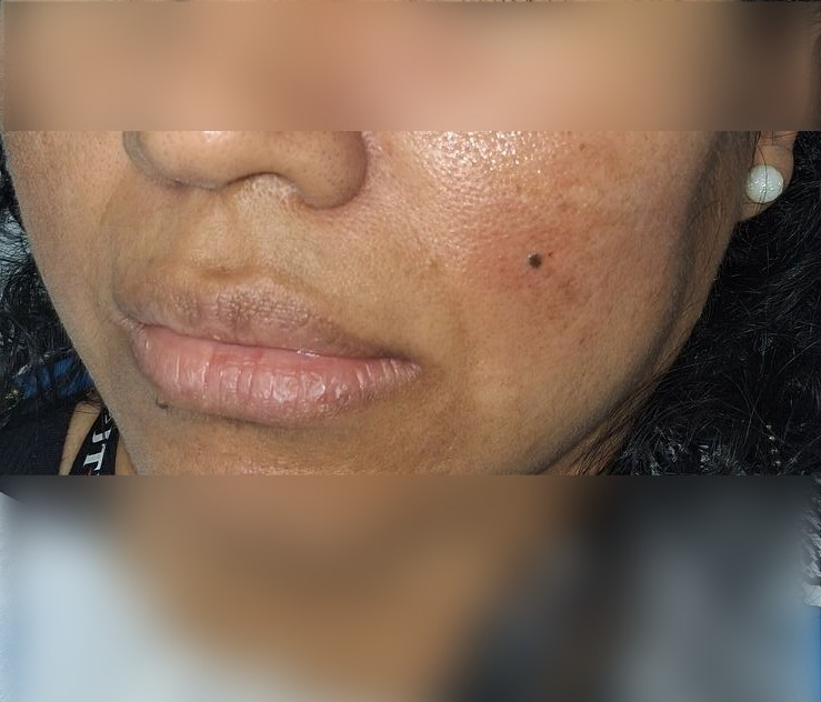 Caso clínico: Nevus compuesto