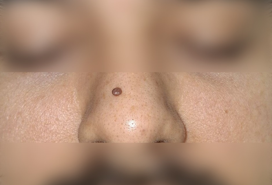 Antes - Caso clínico: Nevus pedunculado