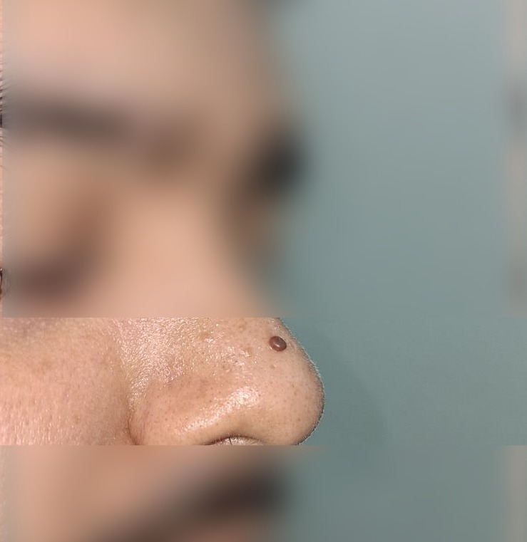 Después - Caso clínico: Nevus pedunculado
