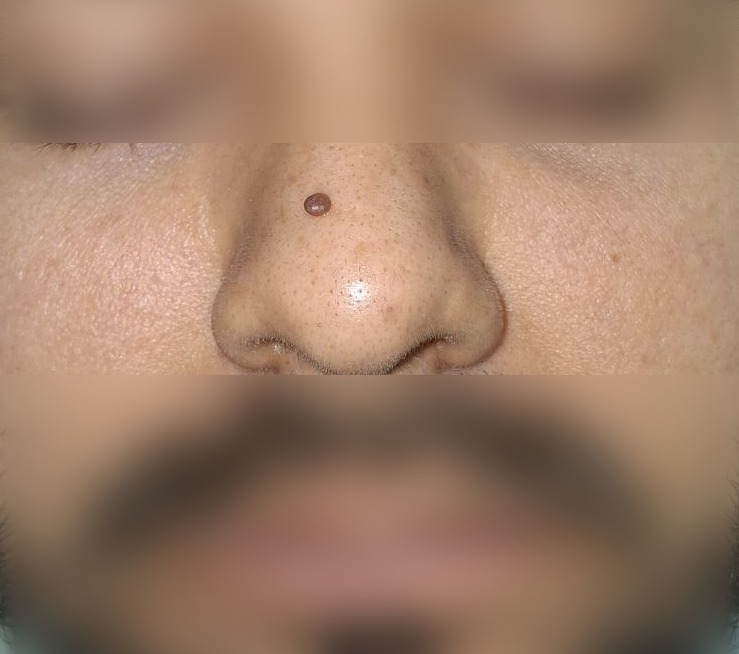 Caso clínico: Nevus pedunculado