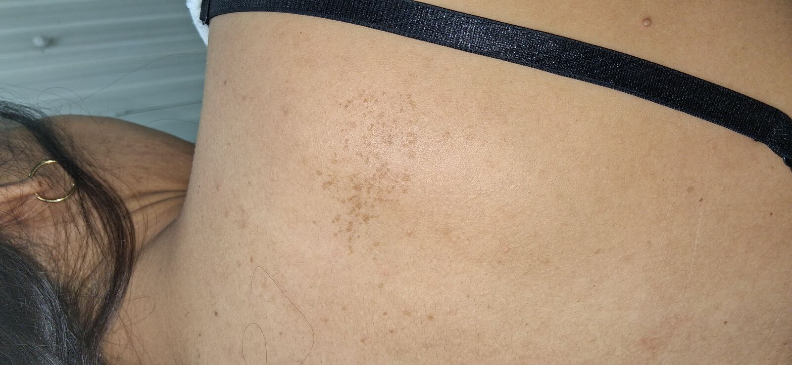 Caso clínico: Nevus spilus